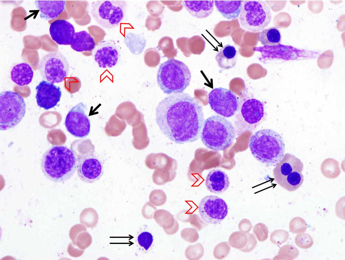 Image 2. Bone marrow aspirate reveals increased blasts (arrows), maturing granulocytic precursors with hypolobulated nuclei including pseudo-Pelger-Huet form (arrow heads). Erythroid precursors exhibit dysplastic changes including binucleation, abnormal hemoglobinization, and basophilic stippling (double arrows).